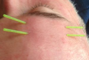 Treating Neuromuscular Facial Conditions: Part 2