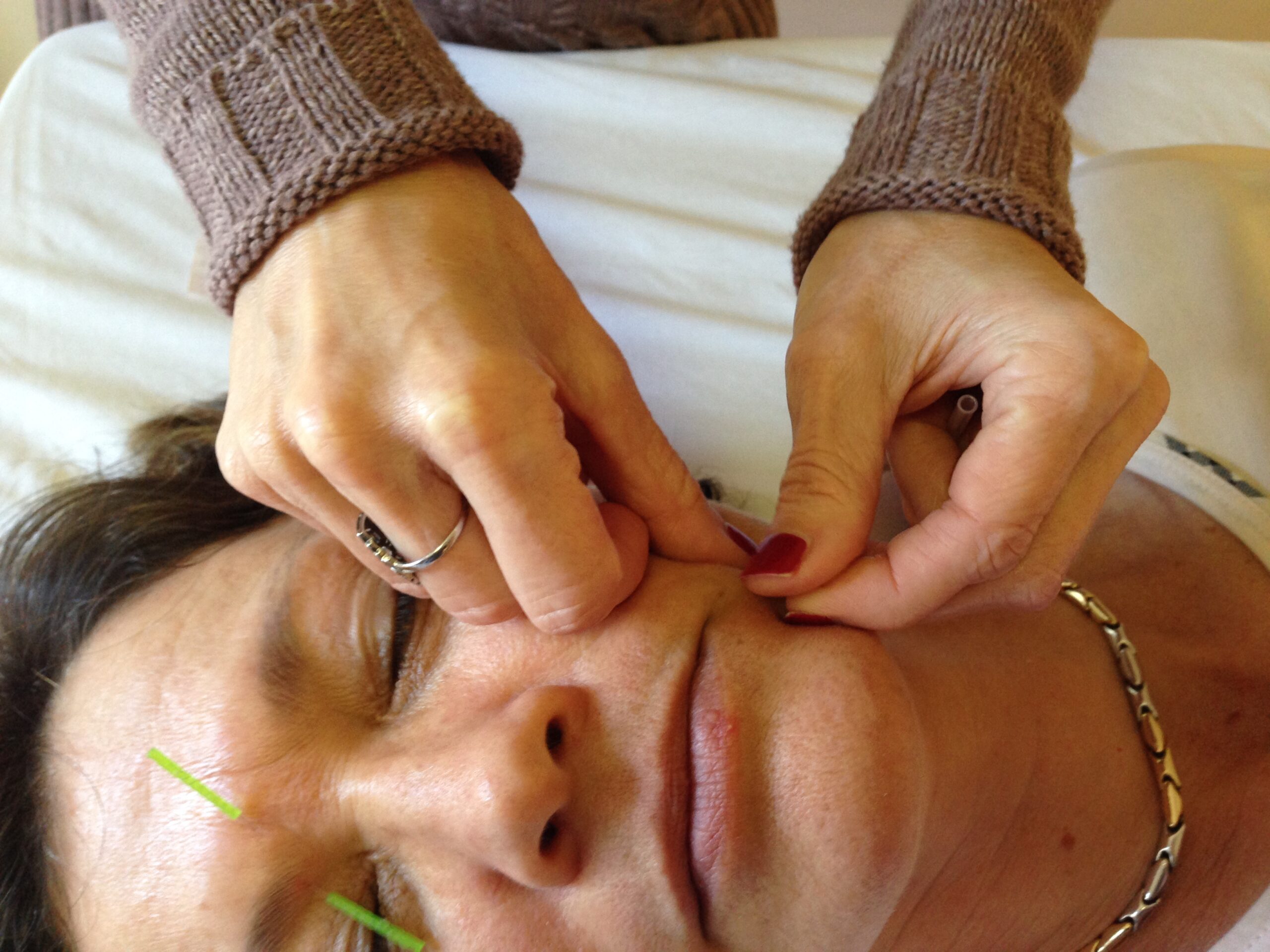 Acupuncture facial pain and neuropathy