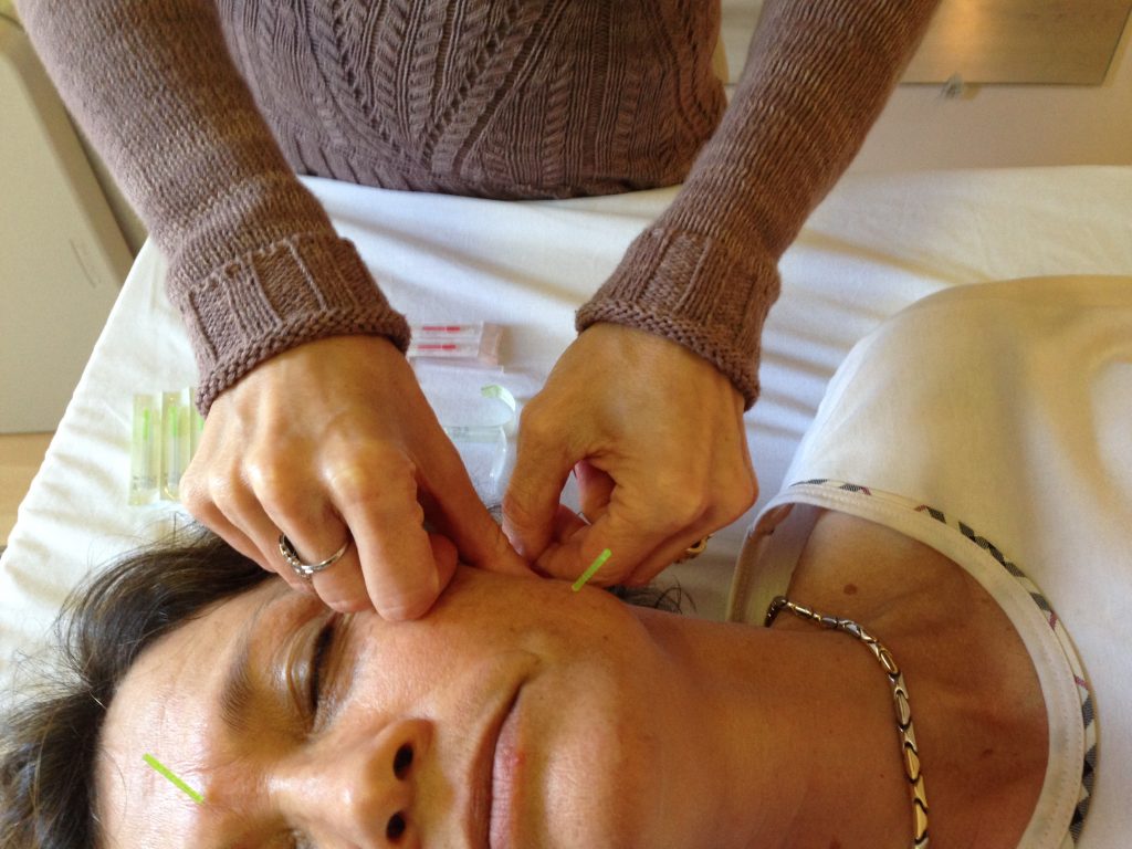 Acupuncture Treatment for Facial Pain and Paralysis