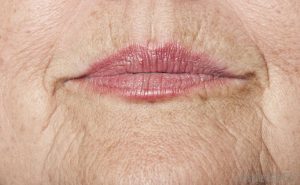 https://facialacupunctureclasses.com/wp-content/uploads/2017/08/lip-wrinkle-photo-300x185.jpg