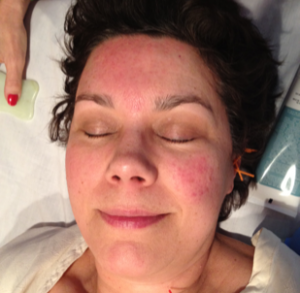 Rosacea treated on right side of face