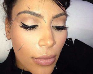 Kardashian Cosmetic Acupuncture