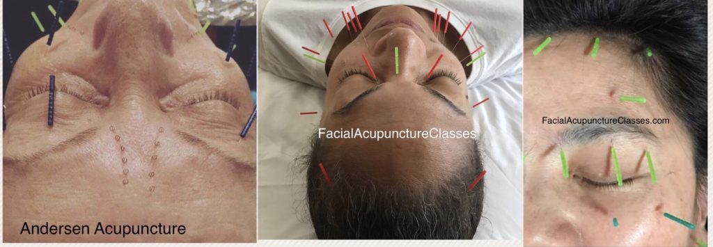 photos of facial acupuncture technique