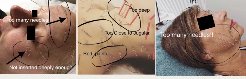 examples of improper facial acupuncture needling. learn how to avoid these mistakes during a Michelle Gellis Facial Acupuncture CEU Certification Classes