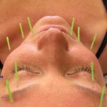 Facial acupuncture training