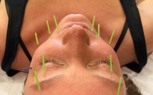 Facial acupuncture training