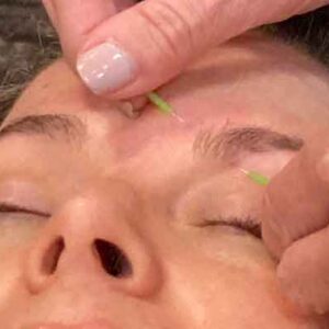 LIVESTREAM 4 CEU WEBINAR – May 31, 2026 – Facial Acupuncture Module 5