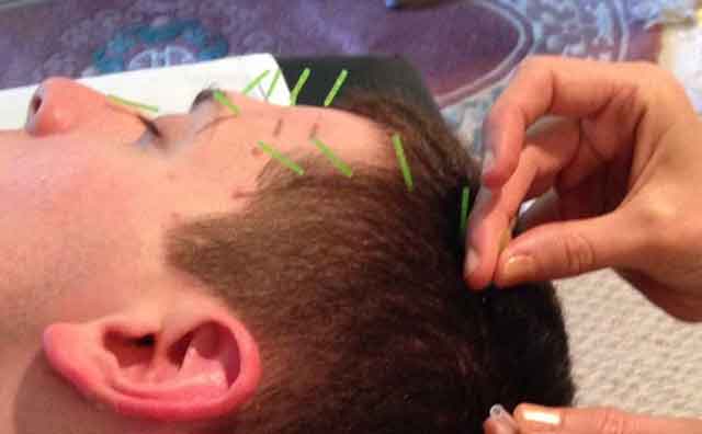 Treating neuromuscular conditions with facial acupuncture