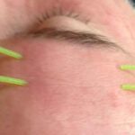 Treating neuromuscular facial conditions with acupuncture
