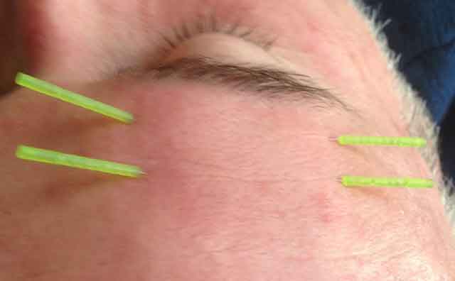 Treating neuromuscular facial conditions with acupuncture