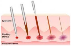 microneedling collagen michelle gellis facial acupuncture classes