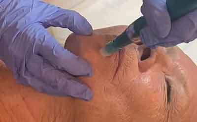 Microneedling for Acupuncturists