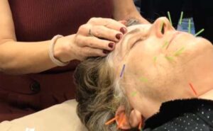 Michelle Gellis demonstrates Safely Needling the Face during cosmetic acupuncture treatment
