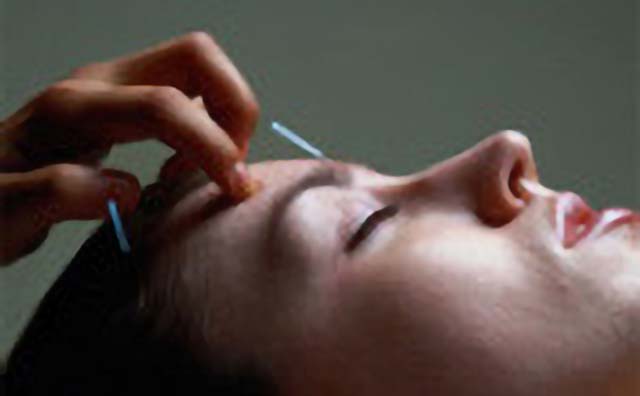 Ethics in Facial Acupuncture