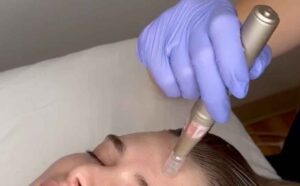 Demonstrating proper use of a microneedling pen
