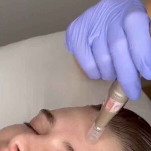 Demonstrating proper use of a microneedling pen