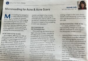 microneedling for acne scars article 