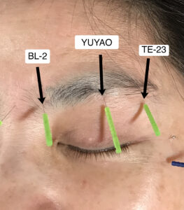 brow lifting with acupuncture