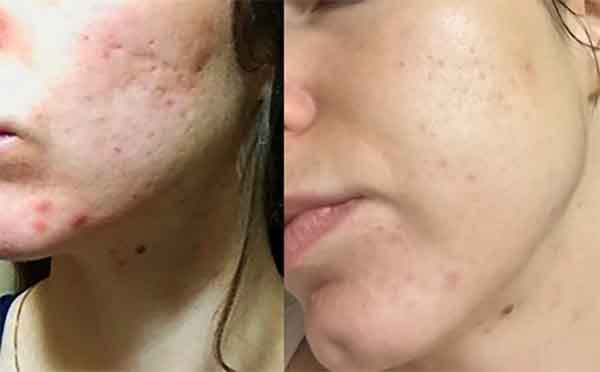 Before and after results of microneedling on acne scars