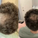 Microneedling for Hair Loss CEU Webinar