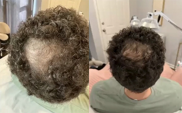 Before and after results of microneedling on the scalp