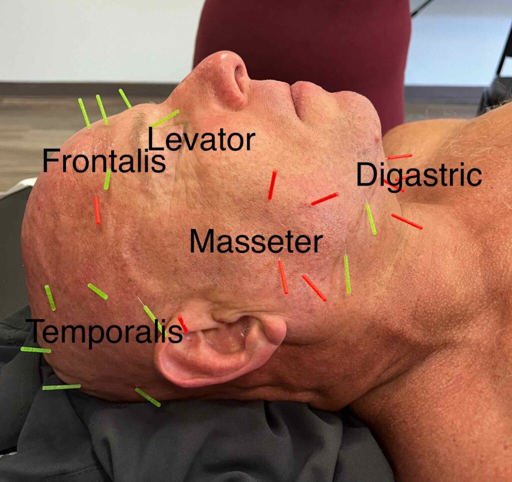submuscular needling of face gellis