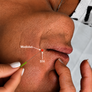 needling modiolus